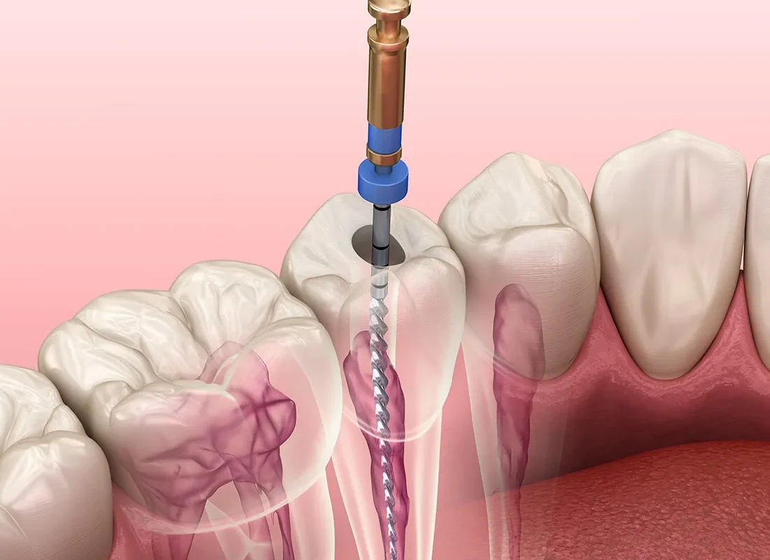Root Canal Therapy in Milwaukee, WI