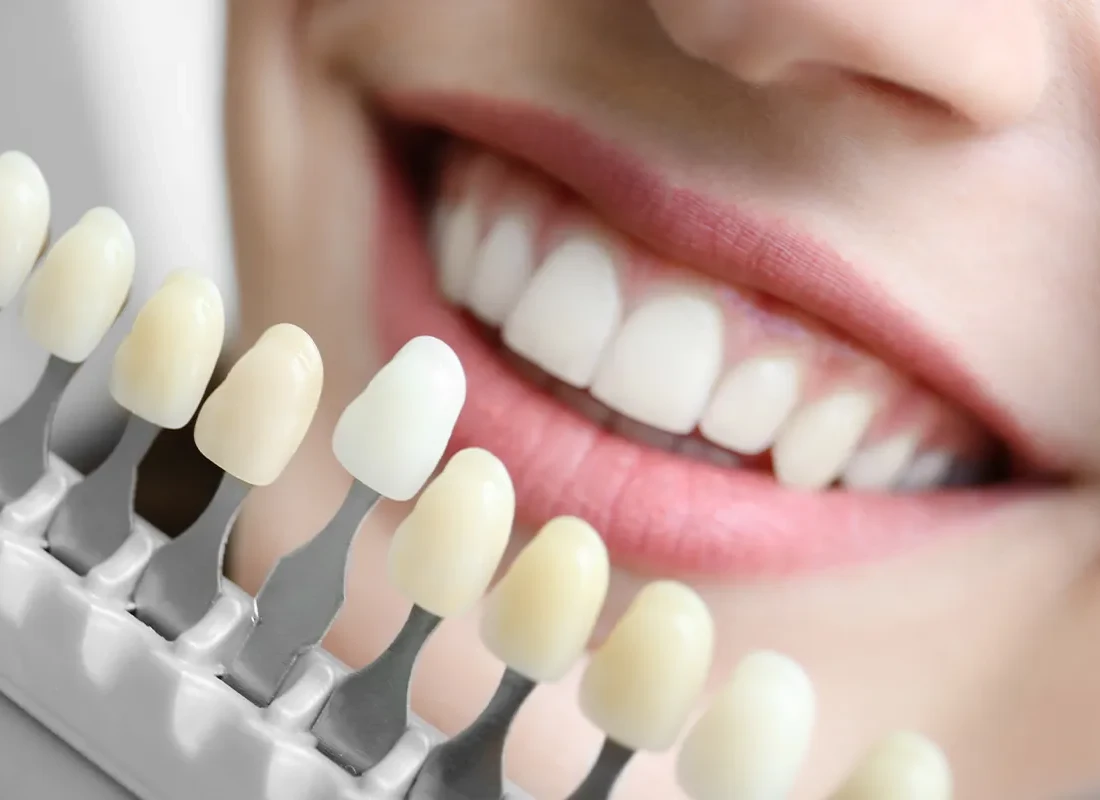 Teeth Whitening at Delicate Smiles