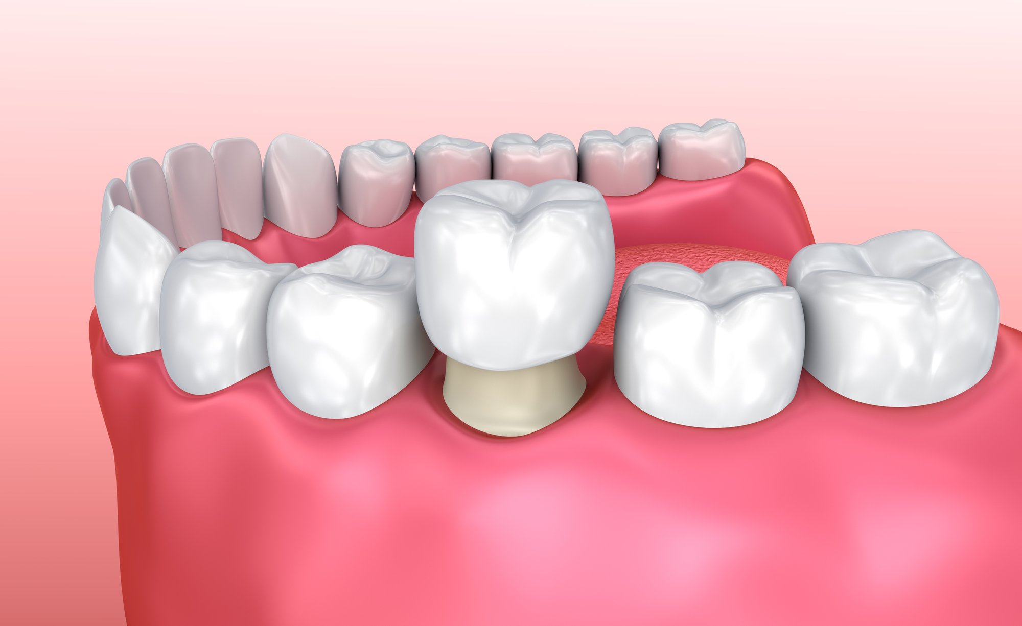 Crown vs. Filling: Which Does My Tooth Need?