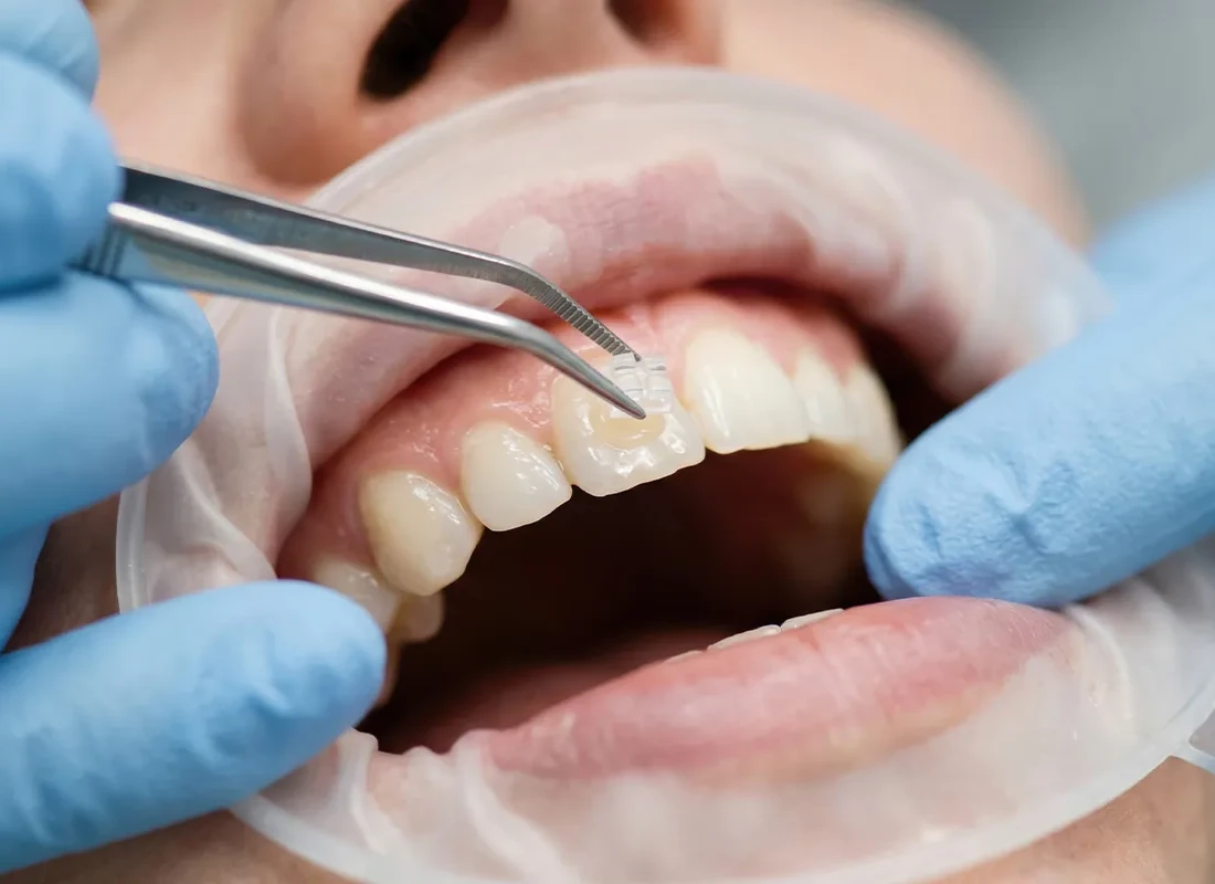 Dental Bonding in Milwaukee, WI