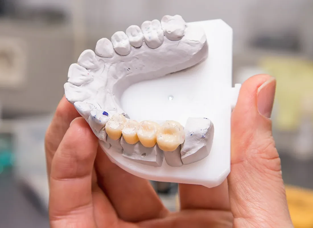 Dental Bridges at Delicate Smiles