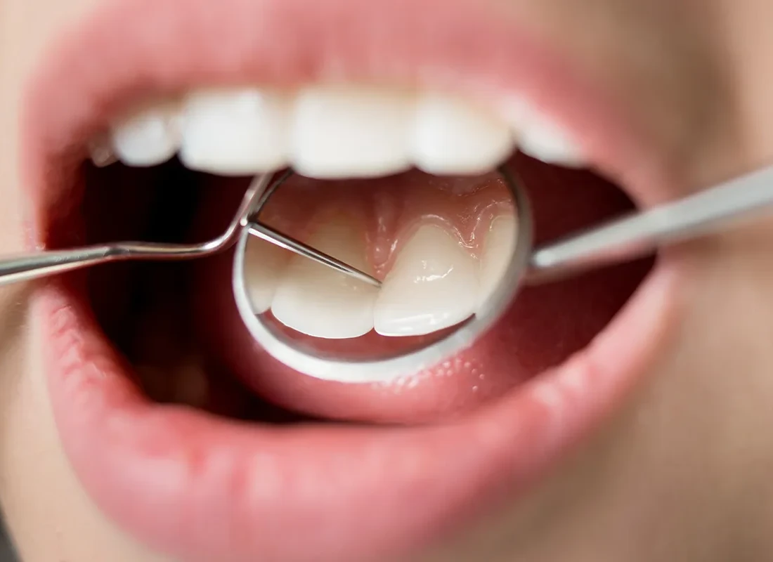 Teeth Cleaning in Milwaukee, WI