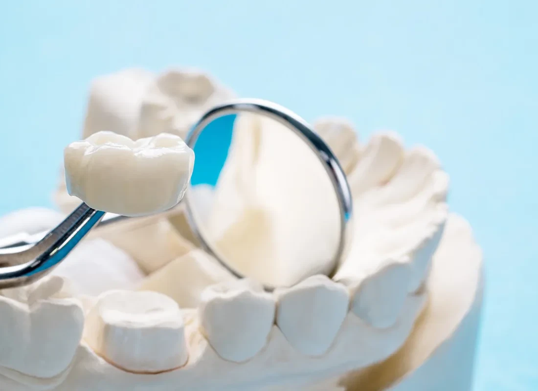 Dental Crowns at Delicate Smiles