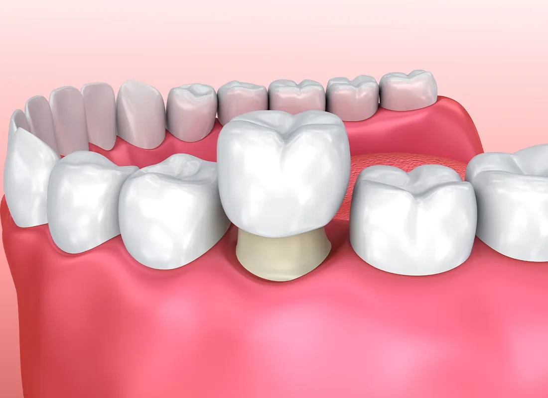 Restorative Dentistry at Delicate Smiles