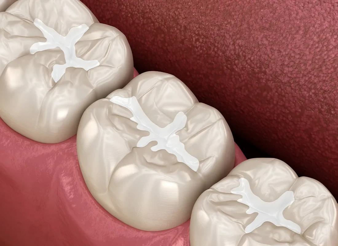 Tooth-Colored Fillings at Delicate Smiles