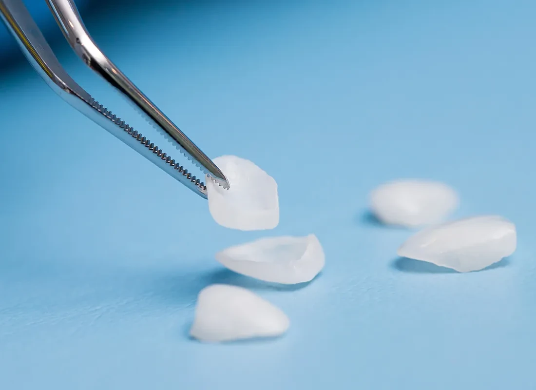 Veneers at Delicate Smiles