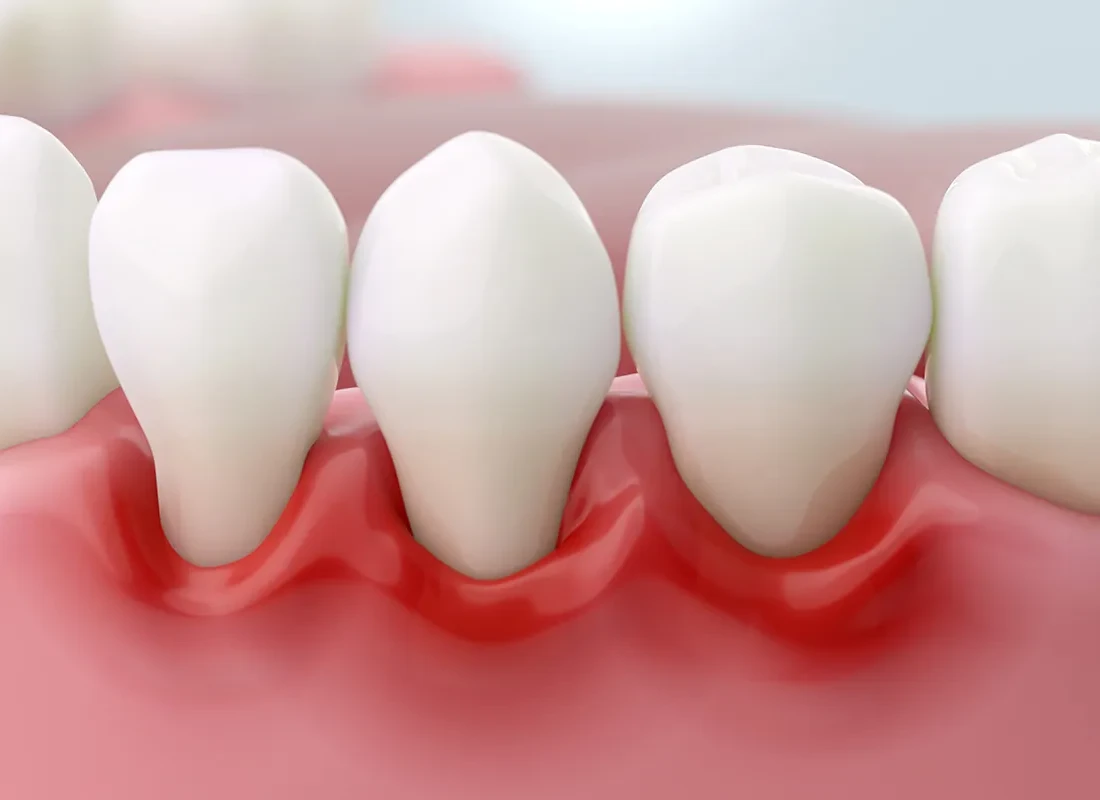 How Do Dentists Treat Gum Disease Without Surgery?