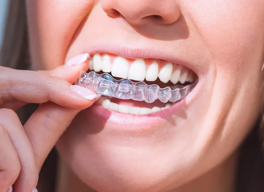 Mouthguards in Milwaukee, WI