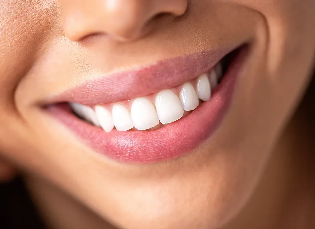 Lip Fillers at Delicate Smiles