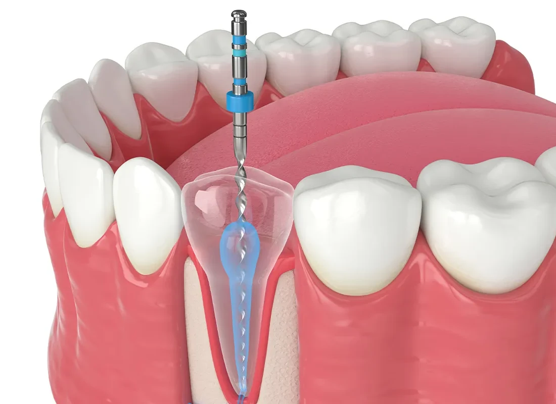 Root Canal Therapy at Delicate Smiles