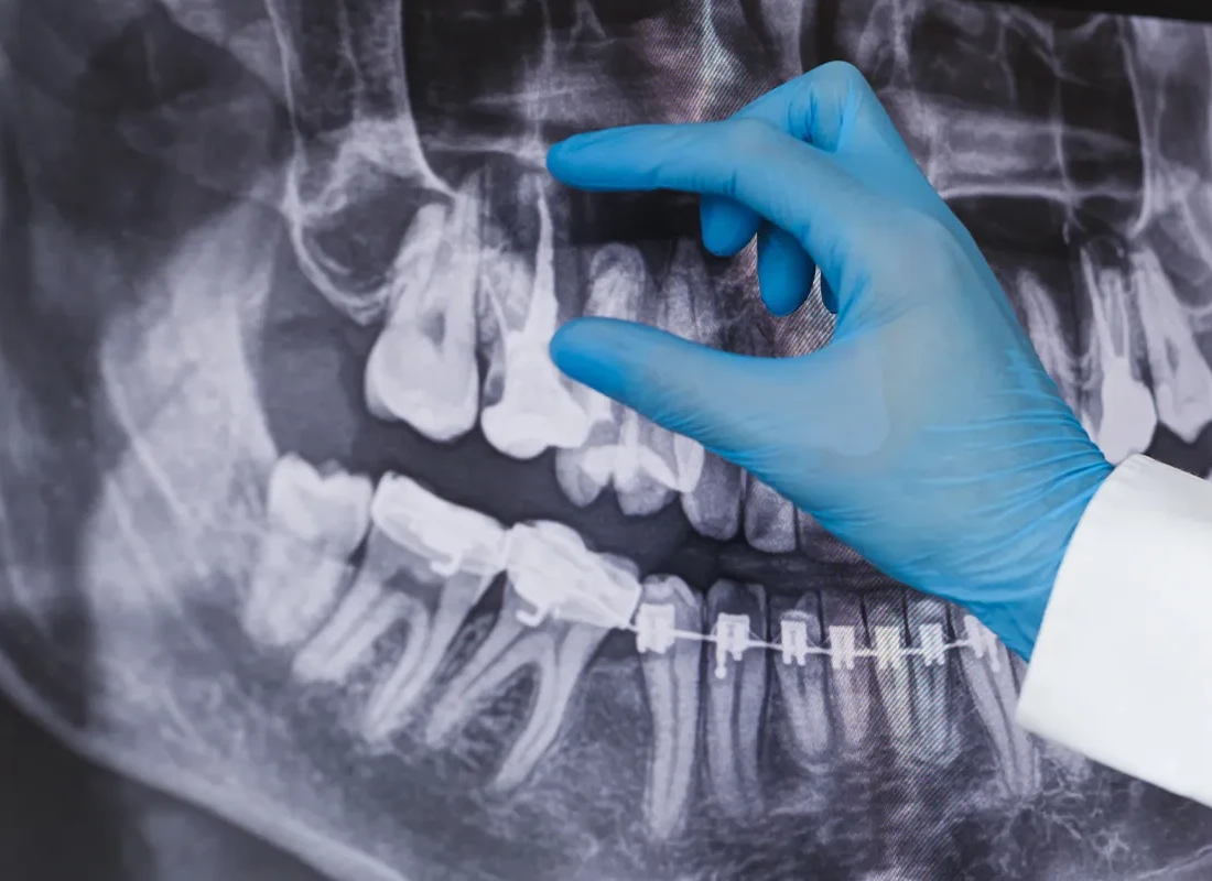 Root Canal Therapy at Delicate Smiles