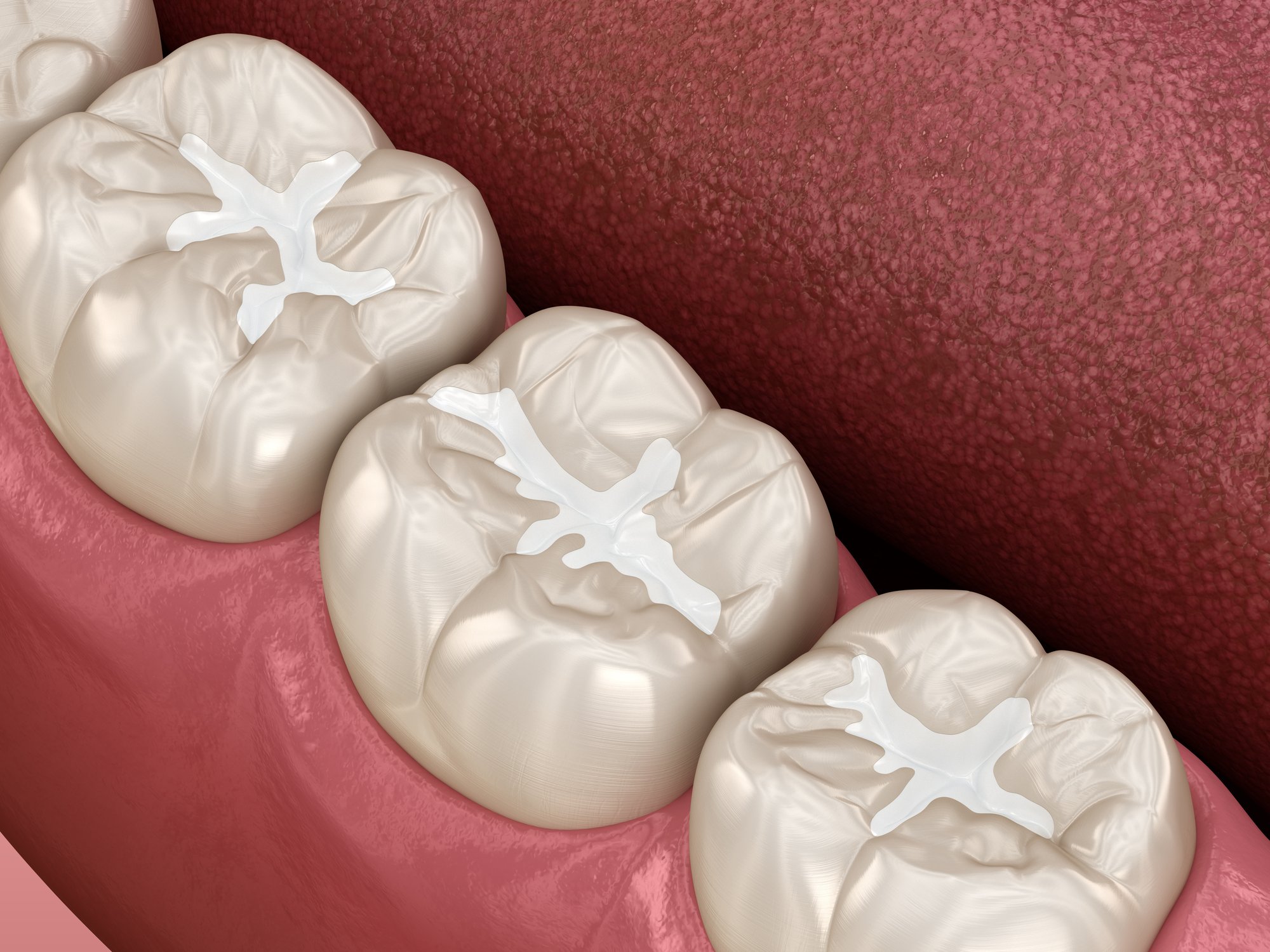 At What Age Should Kids Get Sealants?