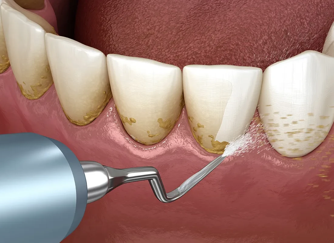 Preventive Dentistry at Delicate Smiles
