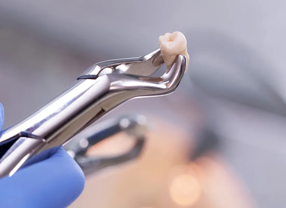 Tooth Extractions at Delicate Smiles