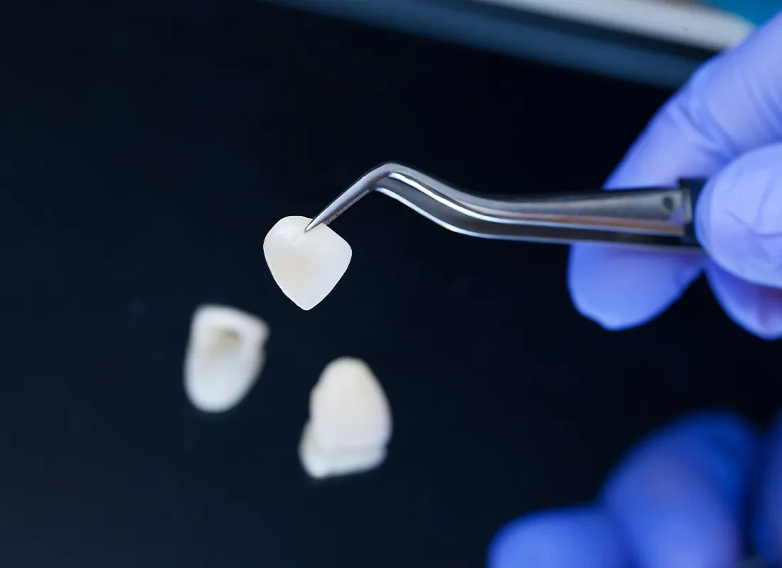 Veneers at Delicate Smiles
