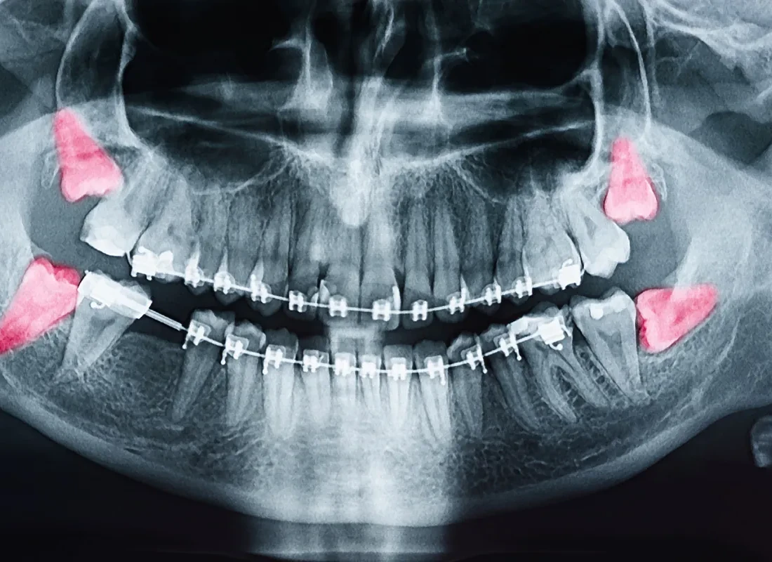 Oral Surgery at Delicate Smiles